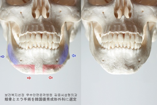 안면윤곽성형 - 최우수병원 김종서성형외과의 사각턱성형 관련 이미지 6