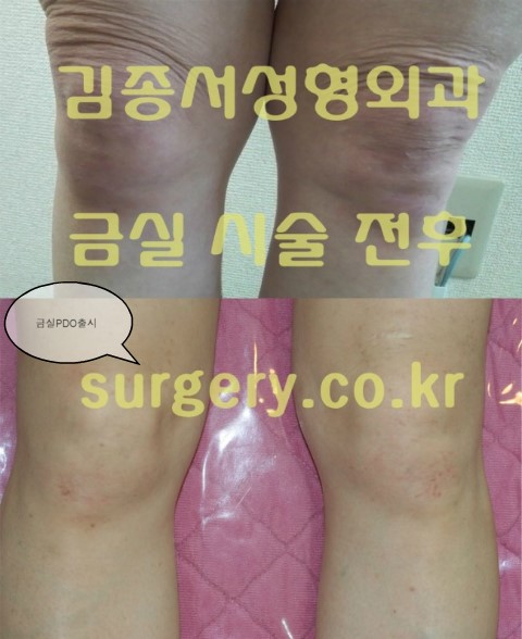 금실PDO매선 한국에서 세계최초 출시 / 김종서성형외과 금실-시술병원 선정 관련 이미지 3