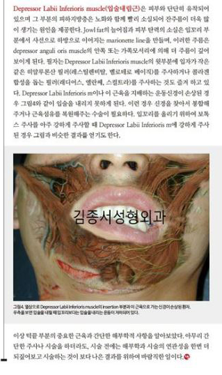 턱끝을 위한 시술방법 / 메디칼S잡지에 실렸습니다 / 김종서성형외과 관련 이미지 5