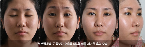 또렷한 눈을 위한 눈성형 - 김종서성형외과 관련 이미지 9