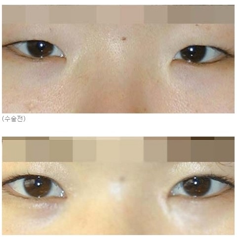 4방향눈확장술 - 압구정눈성형전문 김종서성형외과 입니다 관련 이미지 4
