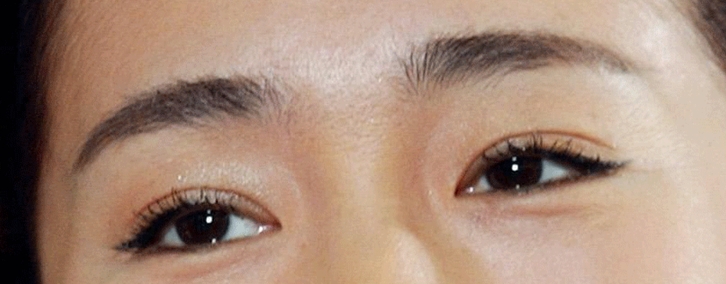 Sinsa-dong Restylane Vital - Pre-Wedding Bride Care image 1