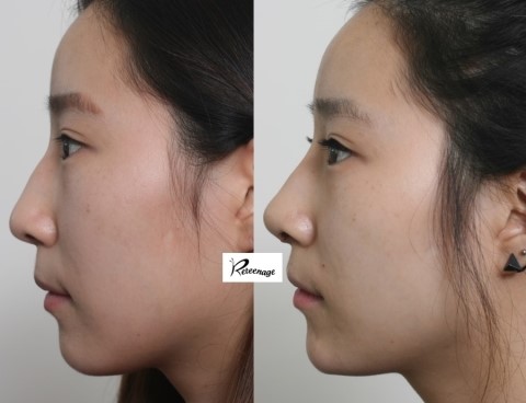 Secret Materials Shared on the Quiet, Nose Surgery!! image 2