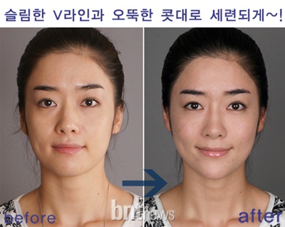 주사한방으로 예뻐지는 레스틸렌 관련 이미지 7