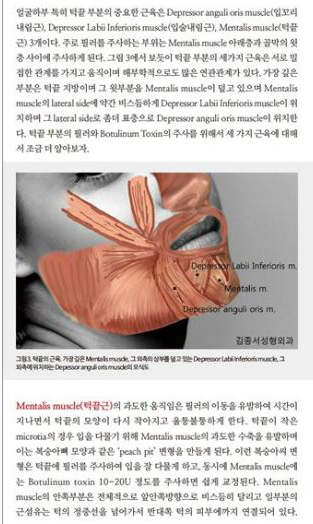 턱끝을 위한 시술방법 / 메디칼S잡지에 실렸습니다 / 김종서성형외과 관련 이미지 3