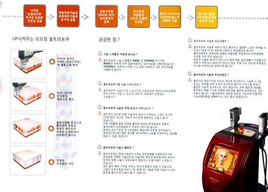 리프팅시술엔 울트라 포머 관련 이미지 1