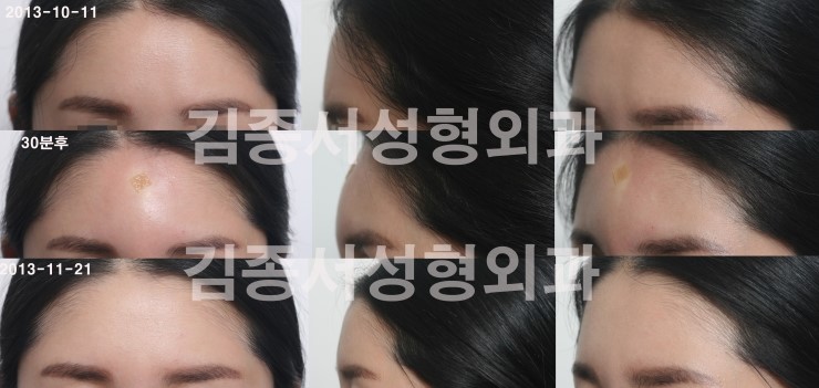래디어스 소식지 / 김종서성형외과 / 래디어스 이마 무턱 모니터요원 모집 / 신청방법 본 링크를 스크랩해서 주소를 함께 보내주세요 surgery@surgery.co.kr 관련 이미지 6