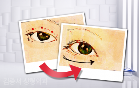 Information That Makes You Prettier When You Read It [Eye Surgery] image 7