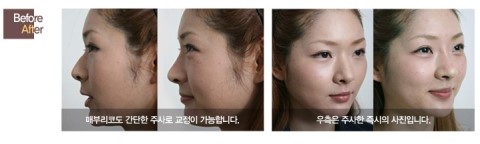 동안얼굴지름길 필러성형 관련 이미지 7