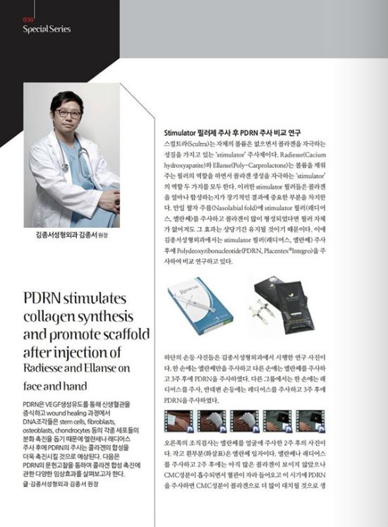 [메디컬S] 메디컬S 5월호 Stimulator 필러제 주사 후 PDRN 주사 비교 연구 관련 이미지 1