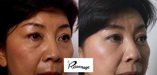 Lower Blepharoplasty at a Gangnam Plastic Surgery Clinic image 4