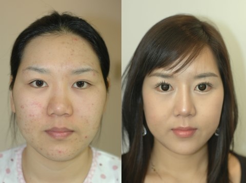 안면윤곽 수술은 전문병원에서! 관련 이미지 1