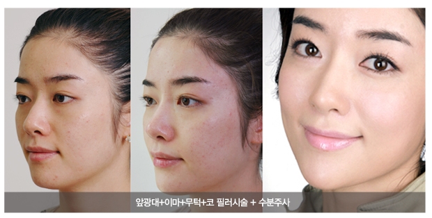 Sinsa-dong Restylane Vital - Pre-Wedding Bride Care image 5
