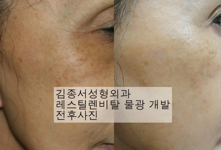 말레이지아 의사들과 피부관리실장님들이 김종서성형외과를 방문해주셨습니다 2011년 10월/레스틸렌 비탈 주사 restylene vital injection / cellfusionc 셀퓨전씨 주사후처치 관련 이미지 2