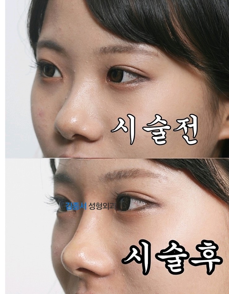 [미스코+필러] 미스코 필러후기 / 미스코 동영상 / 미스코 시술과정 / 김종서성형외과 관련 이미지 1