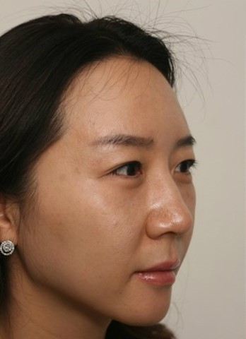 V라인 얼굴라인 실리프팅 (브이락리프팅,실루엣,성형,주름,실리프팅) 관련 이미지 6