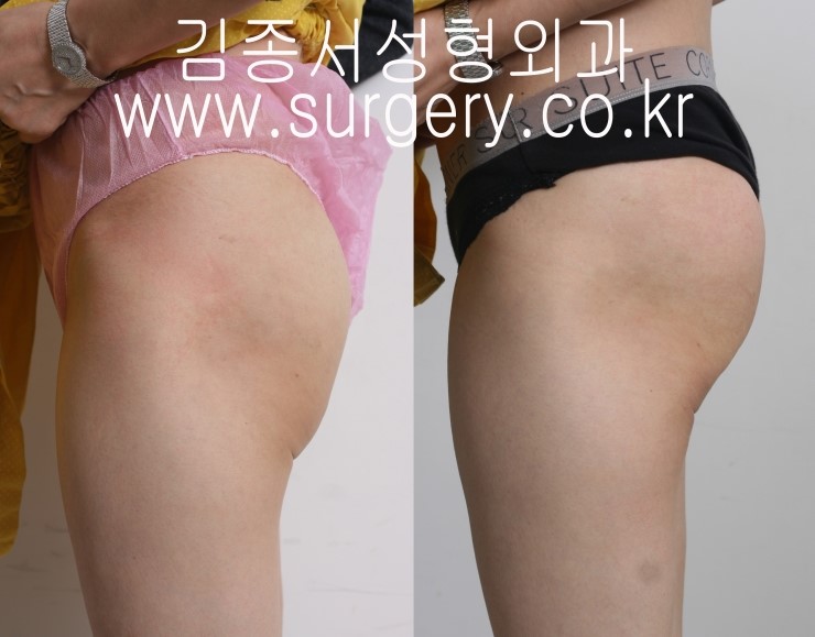 [리프팅] 힙업리프팅 / 힙업실리프팅 / 바디리프팅 / 김종서성형외과 관련 이미지 1