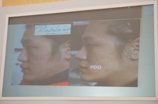I Went to the Restylane 20 Million Treatment Commemoration Beauty Week image 26