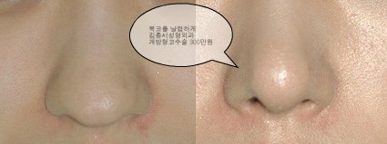 복코를 수술하면 복이 달아나나? 관련 이미지 1