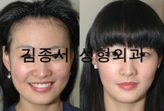 [보톡스 안면윤곽술] 보톡스 주사하나로  사각턱 V라인 만들기! 관련 이미지 2