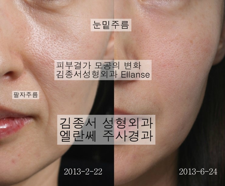 엘란쎄 4개월후 경과사진 김종서성형외과/ (엘란쎄,Ellanse,Radiesse,래디어스,이마필러,이마성형,칼슘필러) 관련 이미지 1