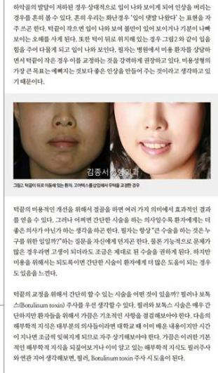 턱끝을 위한 시술방법 / 메디칼S잡지에 실렸습니다 / 김종서성형외과 관련 이미지 2