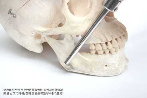 [압구정사각턱수술] 안면윤곽전문 압구정 김종서성형외과의 사각턱수술 정보 관련 이미지 1