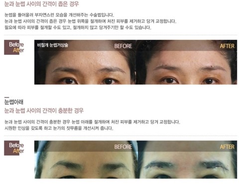 Clearing Up Your Questions! Eye Plastic Surgery image 5