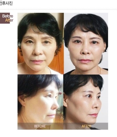 너에게만 알려주는 쁘띠성형 관련 이미지 6