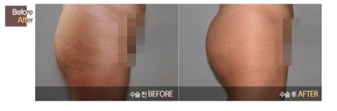s라인 힙업수술 !! 관련 이미지 7