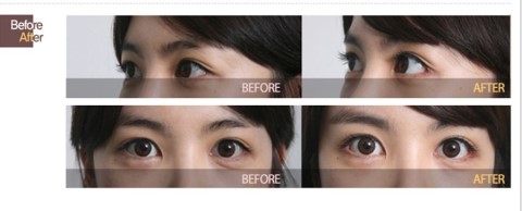 Eye Plastic Surgery: Breaking All the Basic Myths! image 7