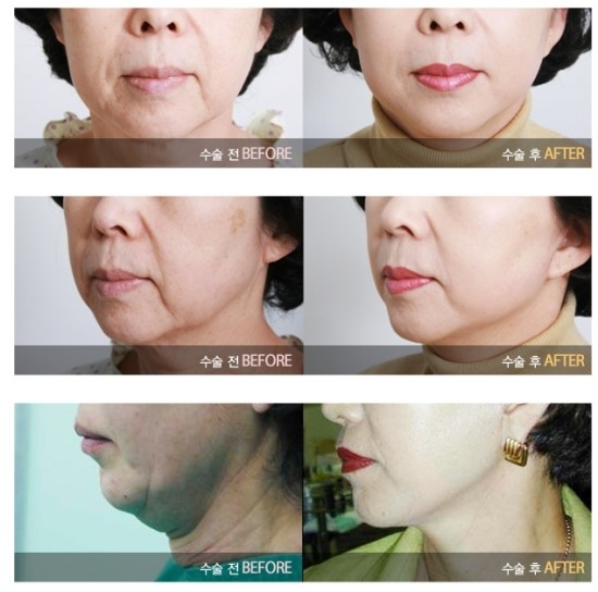 Gangnam Plastic Surgery Wrinkle Removal Surgery / Facelift image 4
