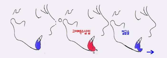 [최우수병원 김종서성형외과] 안면윤곽 #Chapter 1 관련 이미지 6