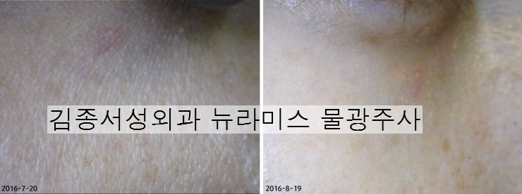 이서진 필러 뉴라미스 물광주사 개발 태국 강의 / 김종서성형외과 관련 이미지 2
