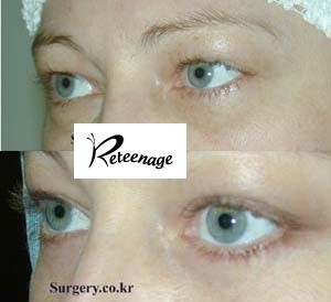 Lower Blepharoplasty at a Gangnam Plastic Surgery Clinic image 5