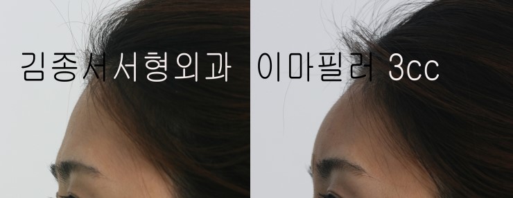 내 얼굴에 가장 잘 어울리는 필러성형은?~~~(restylane,레스틸렌,엘란쎄,Ellanse,Radiesse,래디어스,이마필러,이마성형) 관련 이미지 7
