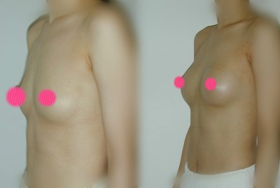 무통,당일퇴원 물방울 가슴성형 관련 이미지 6