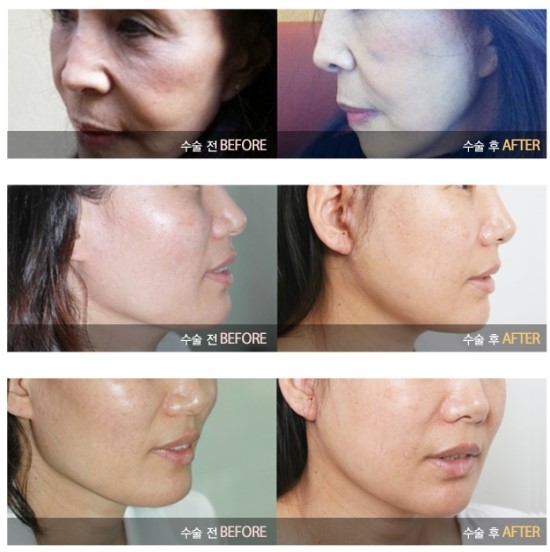Gangnam Plastic Surgery Wrinkle Removal Surgery / Facelift image 1