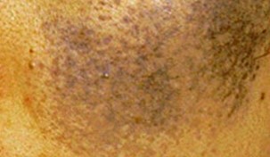 Sinsa-dong Plastic Surgery Clinic - Ota Nevus Treatment image 5