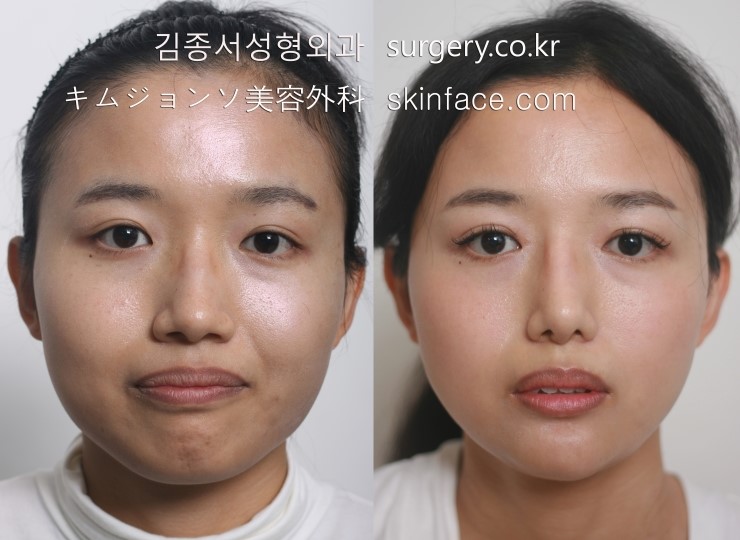 T Osteotomy / V-Line Square Jaw Surgery / Facial Contouring / Kim Jongseo Plastic Surgery, Selected as an Excellent Facial Contouring Hospital by the Ministry of Health and Welfare in 2009 image 3