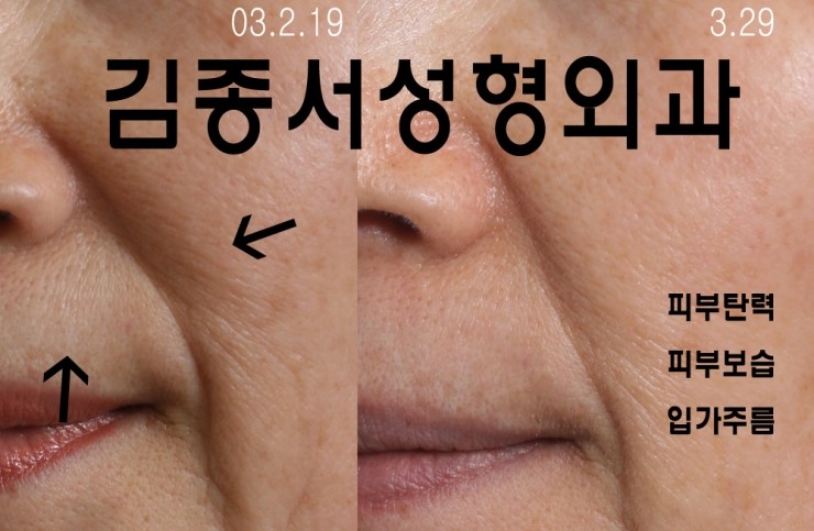 얼굴도 수분을 손실하면 쭈글거리게 마련..ㅠ.ㅠ/ 물광주사/레스틸렌비탈/김종서성형외과/ 관련 이미지 2