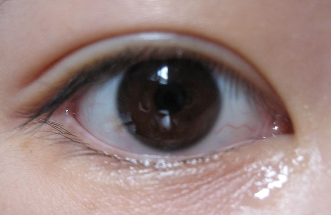 Sinsa-dong Eye Surgery - Speed Buried Suture Method / Double Eyelid Surgery image 3