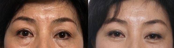 신사동성형외과 쌍커풀 재수술 관련 이미지 2