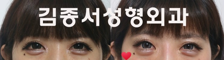밑트임 판다메(팬더의눈) 성형수술 김종서성형외과 관련 이미지 1