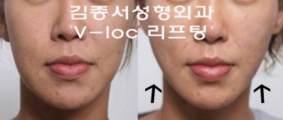 V-loc 180 리프팅 / 비절개 V-loc 시술 2013 대한성형외과학회 발표 김종서성형외과 (브이락리프팅,실루엣,성형,주름,실리프팅) 관련 이미지 1