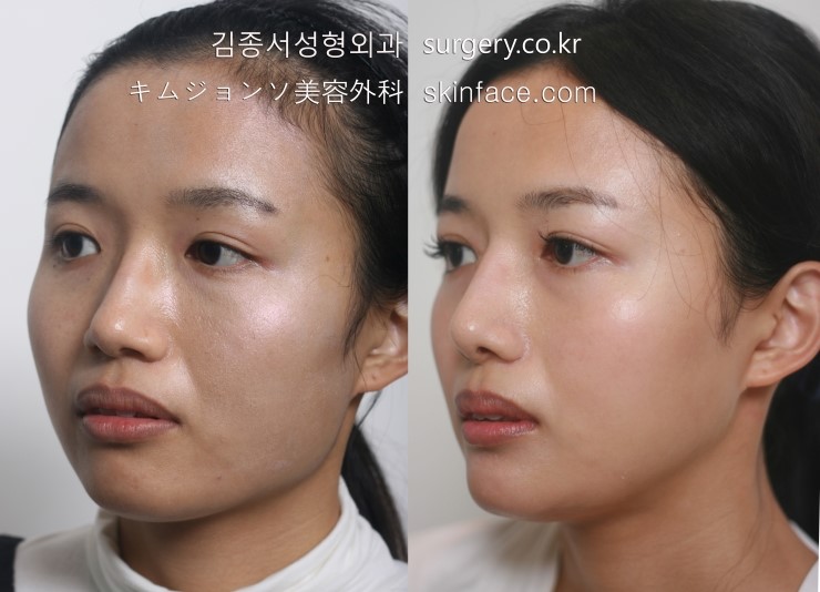 T Osteotomy / V-Line Square Jaw Surgery / Facial Contouring / Kim Jongseo Plastic Surgery, Selected as an Excellent Facial Contouring Hospital by the Ministry of Health and Welfare in 2009 image 2