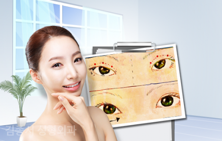 쉽다! 눈성형 관련 이미지 7