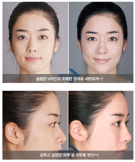 Sinsa-dong Restylane Vital - Pre-Wedding Bride Care image 2