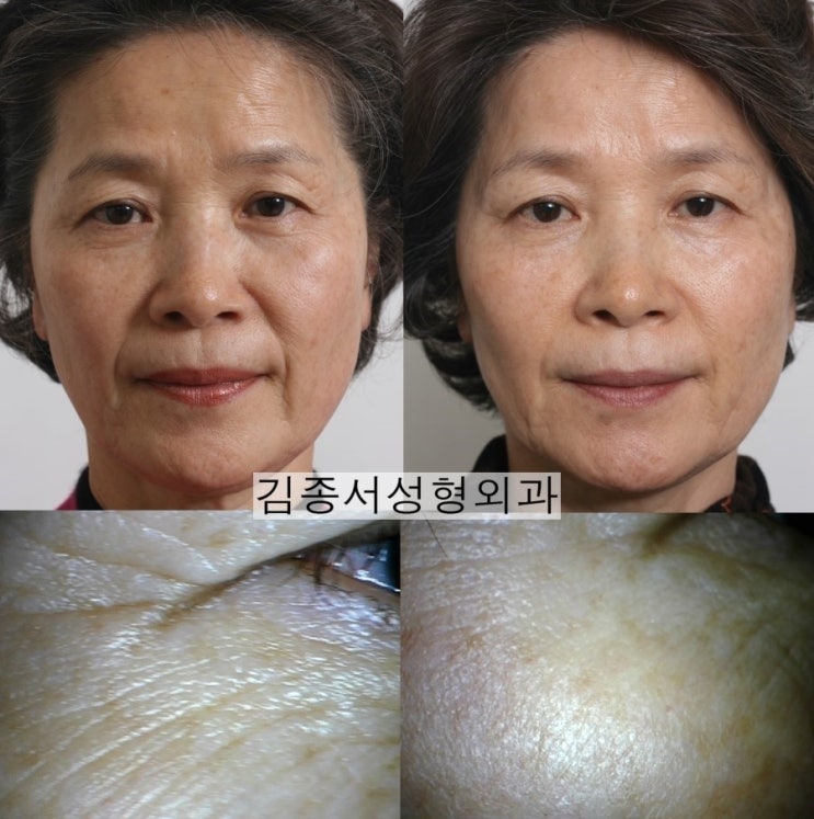 홍콩 레스틸렌 비탈 물광주사 개발 강의 후 한국 레티나지 소개 관련 이미지 15