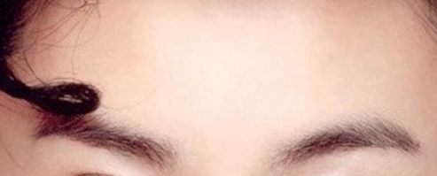 Forehead Wrinkle Removal - Restylane Forehead Filler, Han Go-eun Model Selection image 4